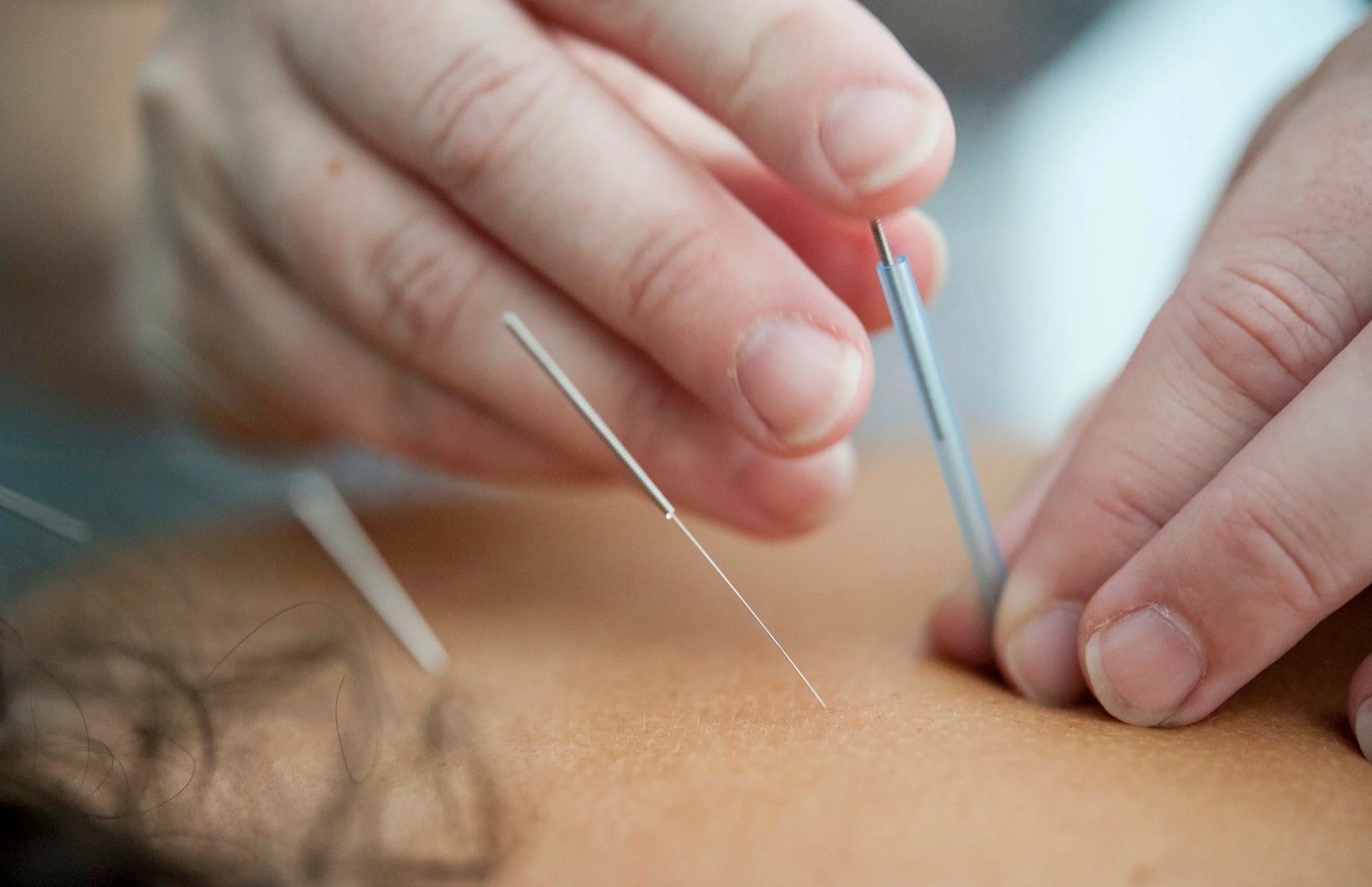 Les mains d’un praticien posent une aiguille d’acupuncture sur le dos d’une patiente.